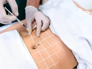 مزوتراپی لاغری