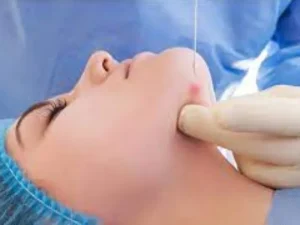 هزینه اندولیفت لاغری