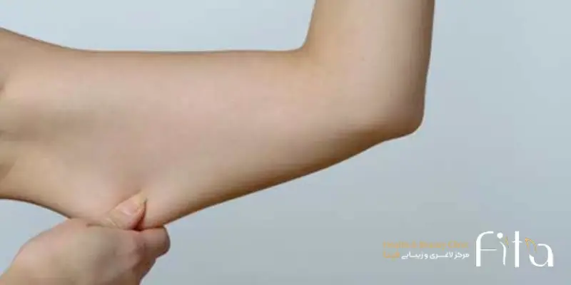 اندولیفت بازو