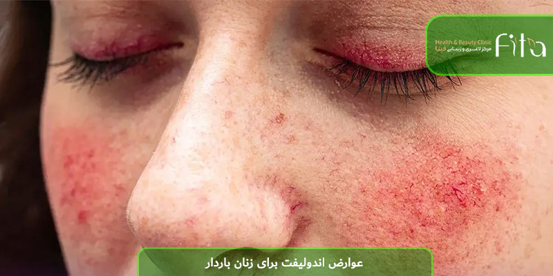 عوارض اندولیفت برای زنان باردار