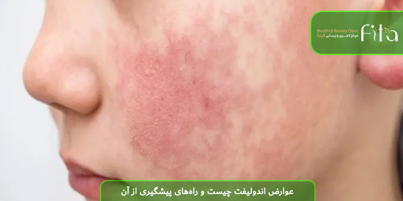 عوارض اندولیفت چیست و راه‌های پیشگیری از آن