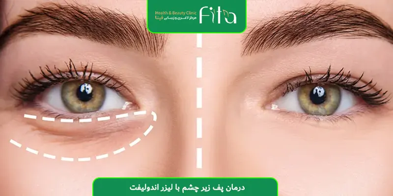 درمان پف زیر چشم با لیزر اندولیفت