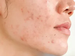 لیزر اندولیفت جای جوش