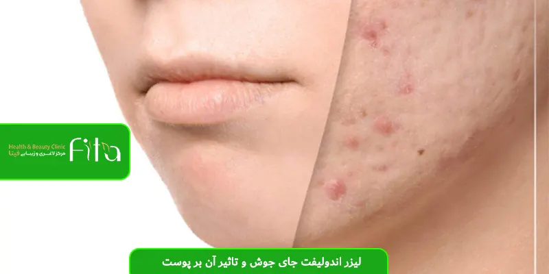 لیزر اندولیفت جای جوش و تاثیر آن بر پوست