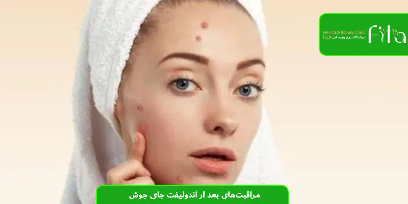 مراقبت‌های بعد ار اندولیفت جای جوش