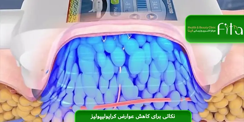 نکاتی برای کاهش عوارض کرایولیپولیز