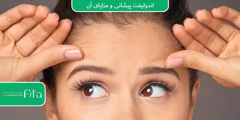 اندولیفت پیشانی و مزایای آن