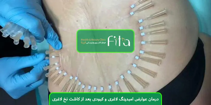 درمان عوارض امبدینگ لاغری و کبودی بعد از کاشت نخ لاغری