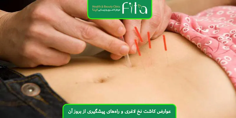 عوارض کاشت نخ لاغری و راه‌های پیشگیری از بروز آن