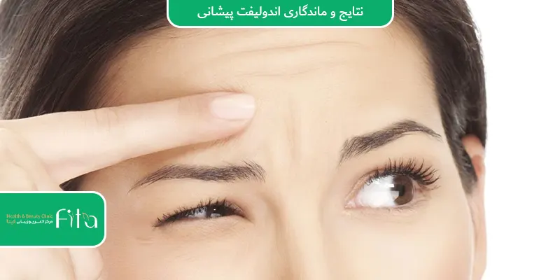 نتایج و ماندگاری اندولیفت پیشانی