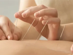 کاشت نخ لاغری