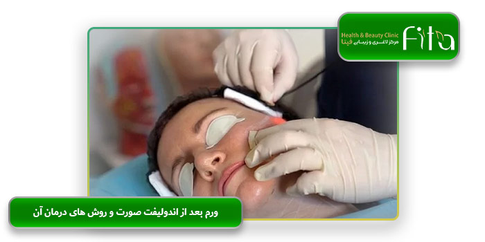 ورم بعد از اندولیفت صورت و روش های درمان آن