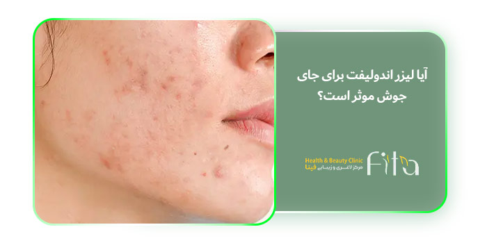 آیا لیزر اندولیفت برای جای جوش موثر است؟