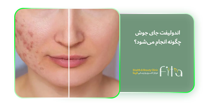 اندولیفت جای جوش چگونه انجام می‌شود؟