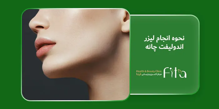 نحوه انجام لیزر اندولیفت چانه