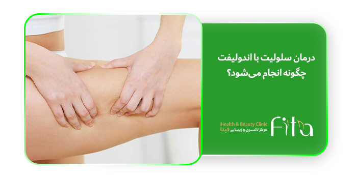 درمان سلولیت با اندولیفت چگونه انجام می‌شود؟