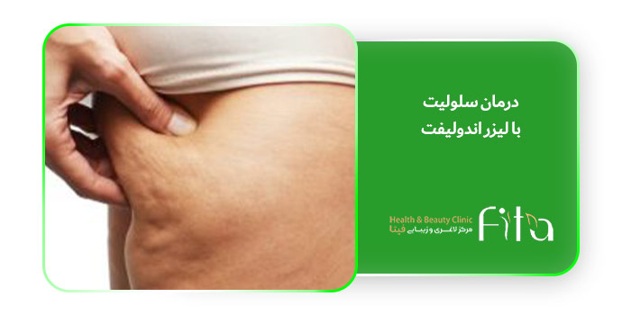 درمان سلولیت با لیزر اندولیفت