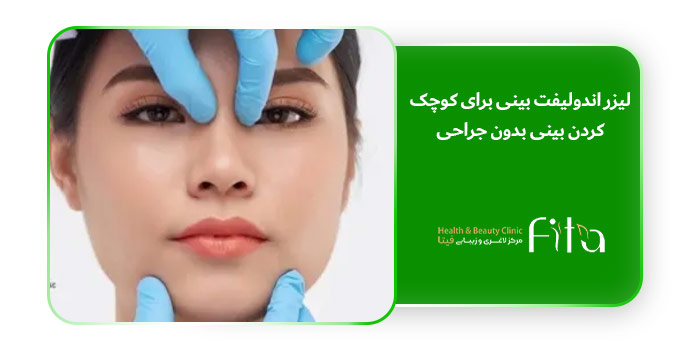 لیزر اندولیفت بینی برای کوچک کردن بینی بدون جراحی