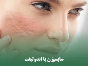 سابسیژن با اندولیفت