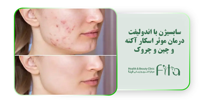 سابسیژن با اندولیفت درمان موثر اسکار آکنه و چین و چروک