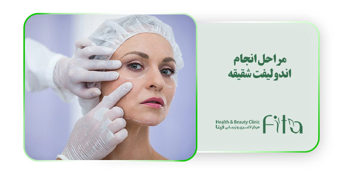 مراحل انجام اندولیفت شقیقه 