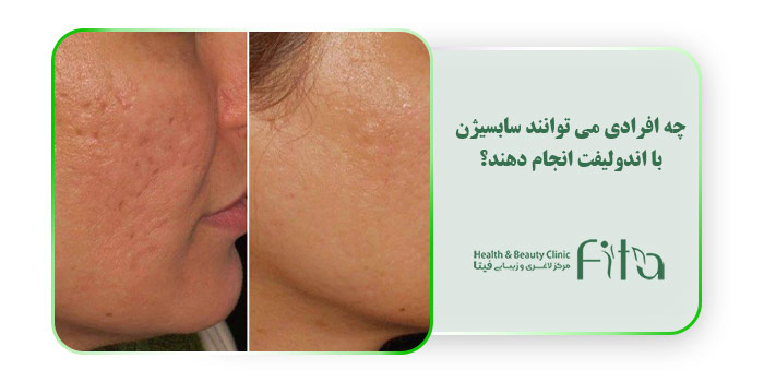 چه افرادی می توانند سابسیژن با اندولیفت انجام دهند؟